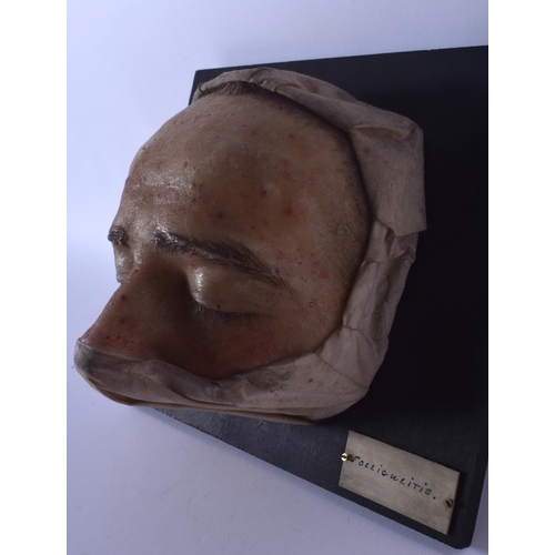 332 - AN UNUSUAL FRENCH ANATOMICAL WAX STUDY OF A DISEASED FACE Folliculitis. 21 cm x 23 cm.