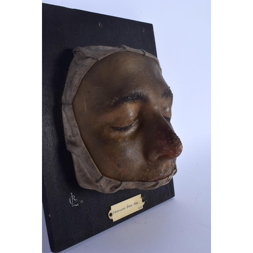 333 - AN UNUSUAL FRENCH ANATOMICAL WAX STUDY OF A DISEASED FACE Granulosis Nasi. 22 cm x 16 cm.