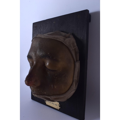 333 - AN UNUSUAL FRENCH ANATOMICAL WAX STUDY OF A DISEASED FACE Granulosis Nasi. 22 cm x 16 cm.