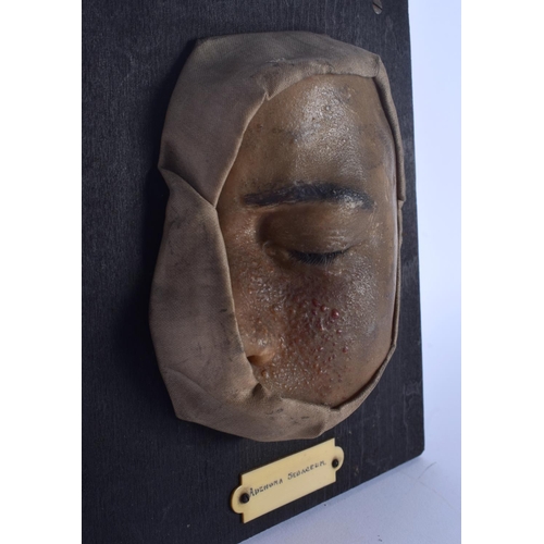 334 - AN UNUSUAL FRENCH ANATOMICAL WAX STUDY OF A DISEASED FACE Adenoma Sebaceum. 18 cm x 15 cm.