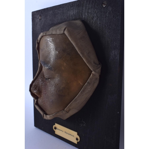 334 - AN UNUSUAL FRENCH ANATOMICAL WAX STUDY OF A DISEASED FACE Adenoma Sebaceum. 18 cm x 15 cm.