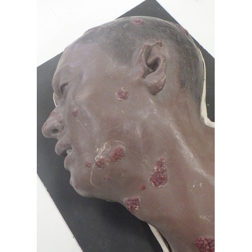 150 - A wax work profile moulage depicting Framboesia Tropica facial disease. A/F damage to ear.