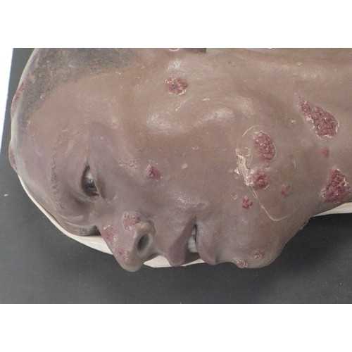 150 - A wax work profile moulage depicting Framboesia Tropica facial disease. A/F damage to ear.