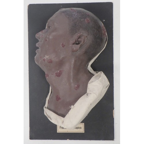 150 - A wax work profile moulage depicting Framboesia Tropica facial disease. A/F damage to ear.