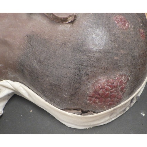 150 - A wax work profile moulage depicting Framboesia Tropica facial disease. A/F damage to ear.