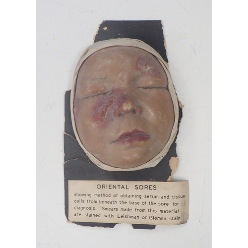 151 - A wax work moulage depicting Oriental Sores on a child's face; other medical interest plasterwork; a... 