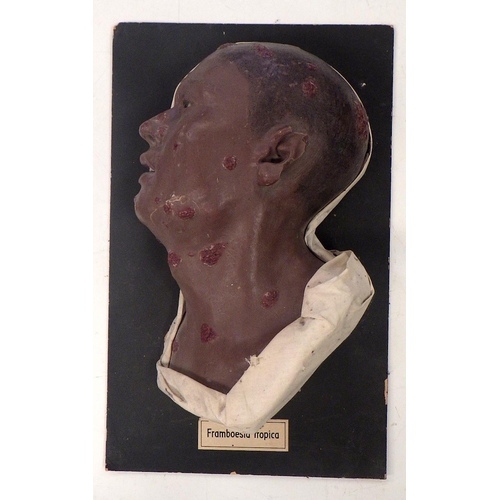 150 - A wax work profile moulage depicting Framboesia Tropica facial disease. A/F damage to ear.