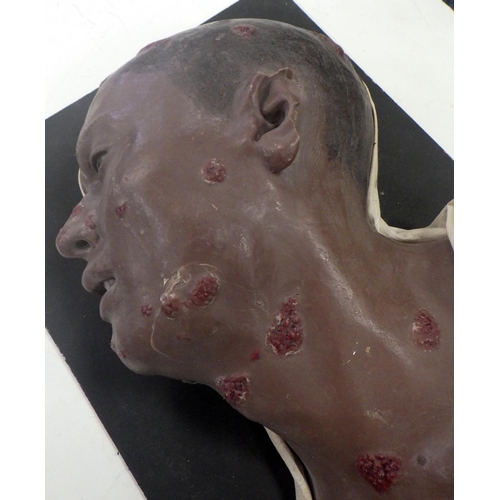 150 - A wax work profile moulage depicting Framboesia Tropica facial disease. A/F damage to ear.