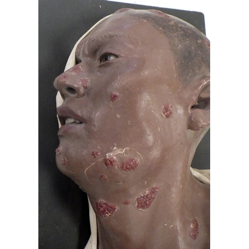 150 - A wax work profile moulage depicting Framboesia Tropica facial disease. A/F damage to ear.