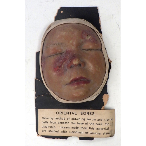 151 - A wax work moulage depicting Oriental Sores on a child's face; other medical interest plasterwork; a... 