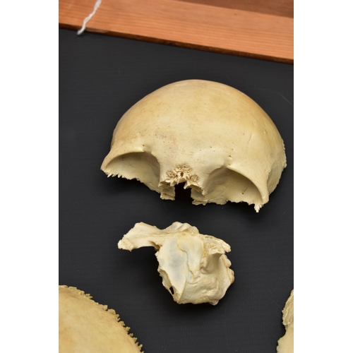 176 - A DECONSTRUCTED HUMAN SKULL IN A WOODEN BOX, the pull off lid interior bears a label for 'Adam Rouil... 