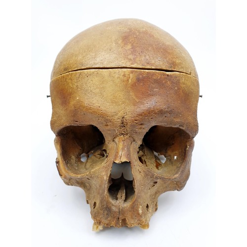 22 - An ex medical human skull, jaw missing. No shipping. Arrange collection or your own packer and shipp... 