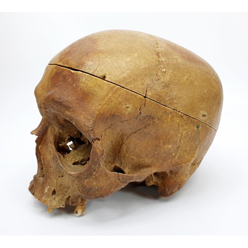 22 - An ex medical human skull, jaw missing. No shipping. Arrange collection or your own packer and shipp... 