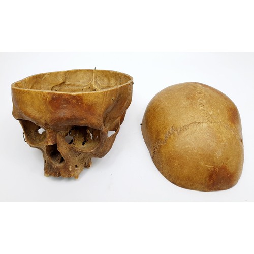 22 - An ex medical human skull, jaw missing. No shipping. Arrange collection or your own packer and shipp... 