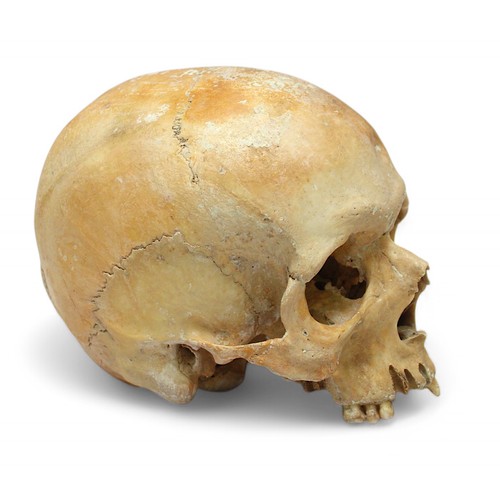 412 - A human skull, lacking the jawbone, the frontal forehead bone with evidence of blunt trauma.