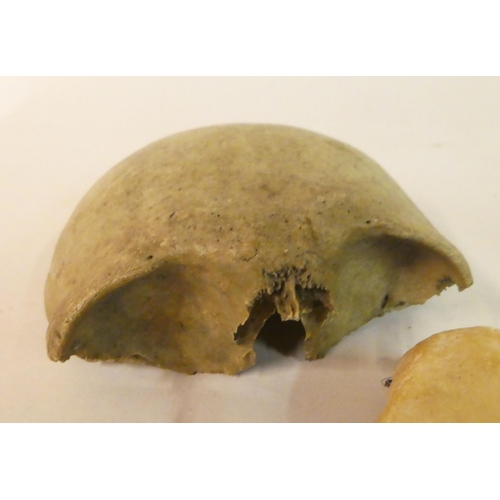 147 - Medical specimens: to include part of a cranium; a jaw; a skeleton hand; and a foot