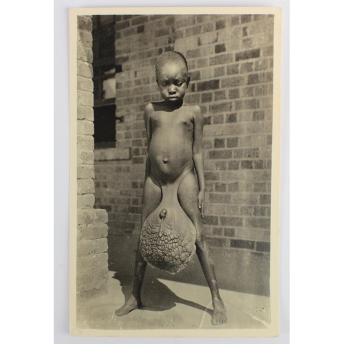 1130 - Medical. Elephantiasis - nude native child with swollen testicles, real photo postcard published by ... 