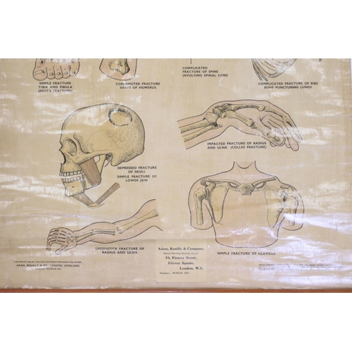 461 - Adam, Rouilly & Company Anatomical Poster of ' First Aid Fracture Chart ' from original drawings by ... 