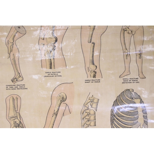 461 - Adam, Rouilly & Company Anatomical Poster of ' First Aid Fracture Chart ' from original drawings by ... 