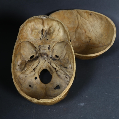 128 - WITHDRAWN - Human Anatomy - An Antique full human skull, with calvarium cut cranium with hook and st... 