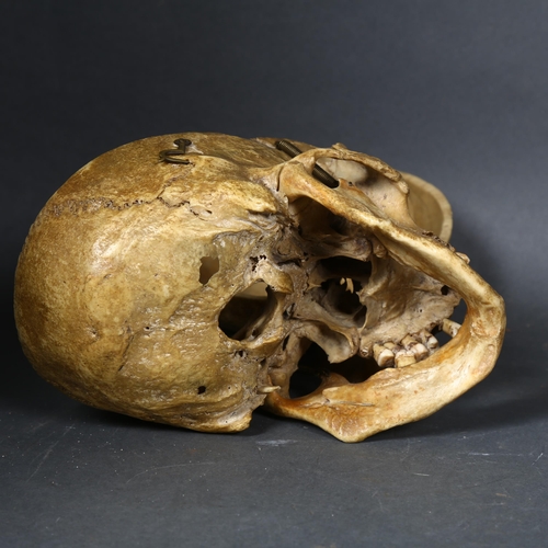 128 - WITHDRAWN - Human Anatomy - An Antique full human skull, with calvarium cut cranium with hook and st... 