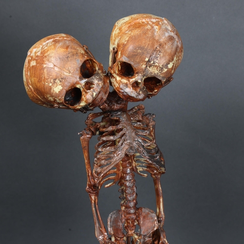 3005 - Curiosity/Macabre : A composite conjoined foetal skeleton, housed under a modern glass dome, height ... 