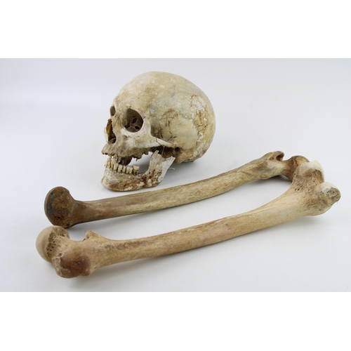 29 - Early c19th real human skull together with two antique human femur bones as anatomical specimens (3)... 