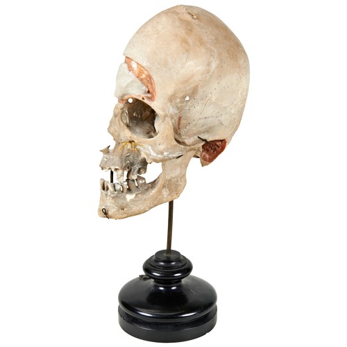 308 - A HUMAN HALF SKULL MOUNTED FOR ANATOMICAL USE, drilled and painted to illustrate vein patterns and m... 