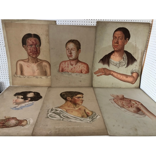 81 - (Medical Interest) Twelve Victorian / Edwardian  Educational Illustrations of Skin Disease: Selectio... 