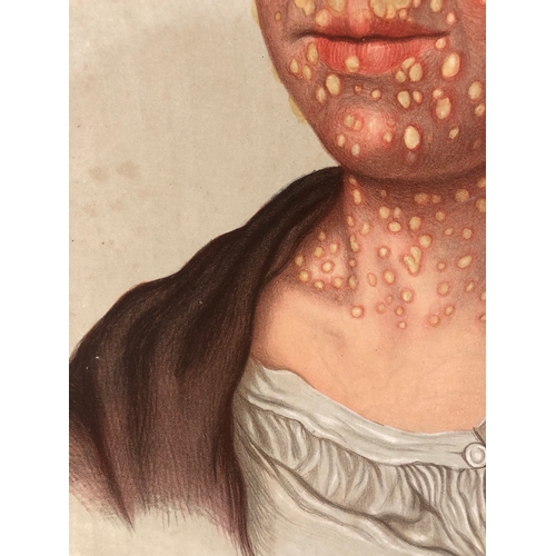 81 - (Medical Interest) Twelve Victorian / Edwardian  Educational Illustrations of Skin Disease: Selectio... 