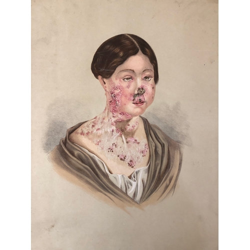 81 - (Medical Interest) Twelve Victorian / Edwardian  Educational Illustrations of Skin Disease: Selectio... 