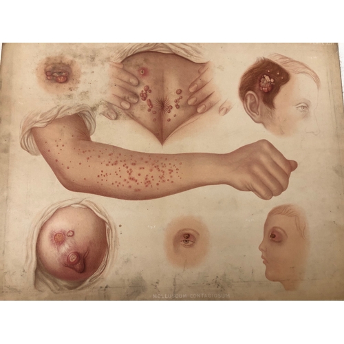 84 - (Medical Interest) Ten Victorian / Edwardian  Educational Illustrations of Skin Disease: Selections ... 