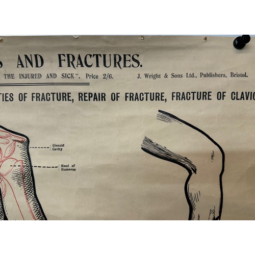 49 - Early C20th linen backed First Aid poster, dislocations and Fractures, 101 cm x 66 cm.

This lot is ... 