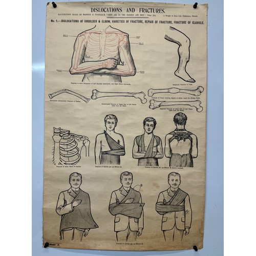 414 - Early C20th linen backed First Aid poster, dislocations and Fractures, 101 cm x 66 cm.

This lot is ... 