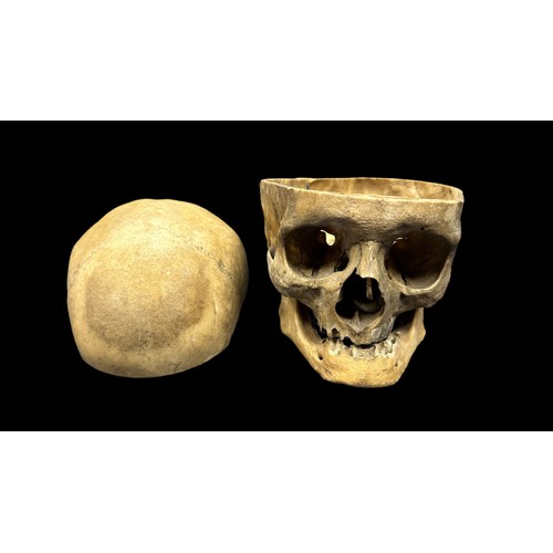 374 - Dental Study - Human Skulls. Believed to have been used for dental medical study/research. One skull... 