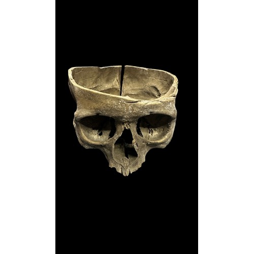 374 - Dental Study - Human Skulls. Believed to have been used for dental medical study/research. One skull... 