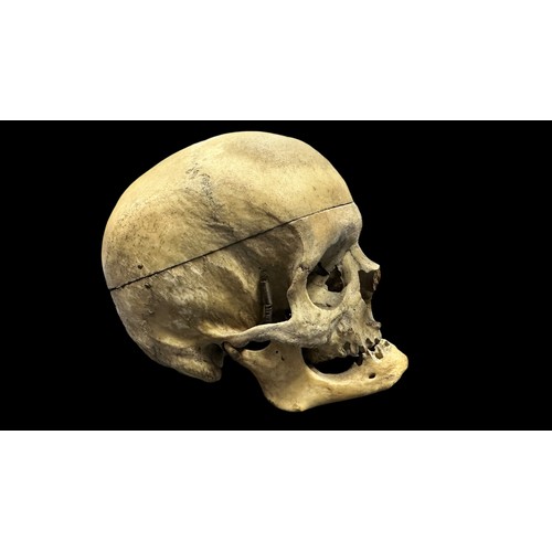 374 - Dental Study - Human Skulls. Believed to have been used for dental medical study/research. One skull... 