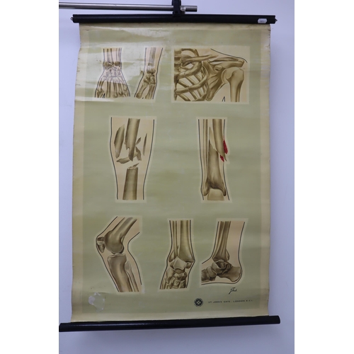 351 - Two St Johns Ambulance 1970s Anatomical Fracture Wall Charts (87cm x 55cm)