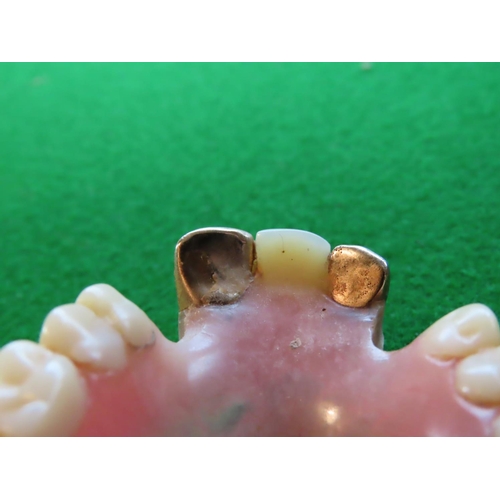 766 - Two Gold Dental Crowns on Lower Set of False Teeth Good Gold Content Owner Now Deceased