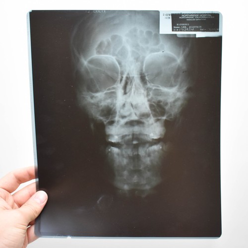 277 - A Collection Of 6 X-Ray Medical Pictures Of A Human Skull