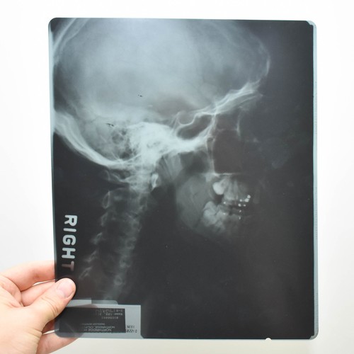 277 - A Collection Of 6 X-Ray Medical Pictures Of A Human Skull