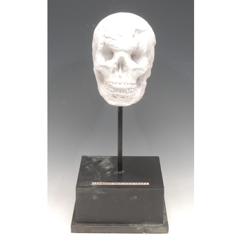 3490 - The Macabre - Medical Interest and Interior Decoration - a plaster facsimile, Leprosy Diseased Skull... 