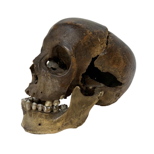 1045 - Early 20th century human medical skull, the lower jaw with teeth mostly intact, a/f (in three sectio... 