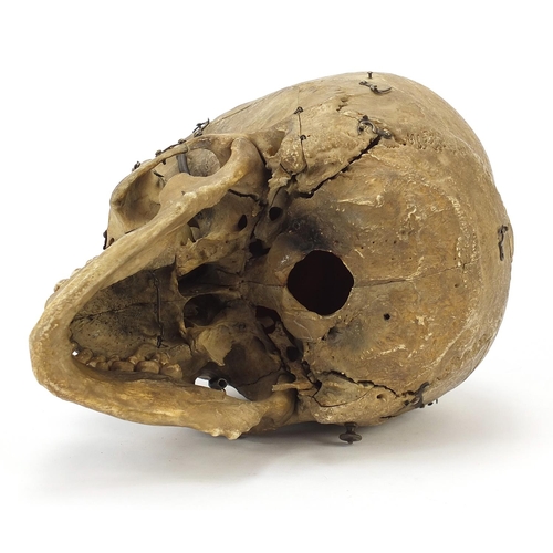 7 - 18th/19th century dissected medical human skull with Latin inscriptions and pine box, the skull 24cm... 