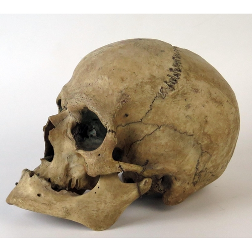 181 - Antique Human Skull with wired jaw