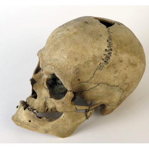 181 - Antique Human Skull with wired jaw