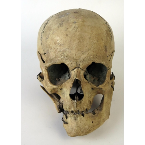 181 - Antique Human Skull with wired jaw