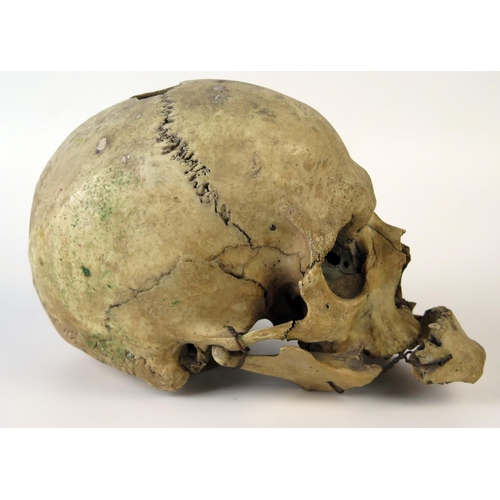 181 - Antique Human Skull with wired jaw