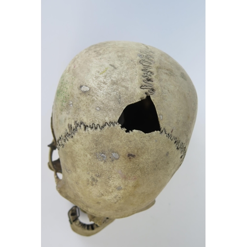 181 - Antique Human Skull with wired jaw