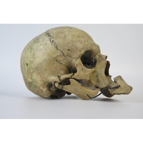 181 - Antique Human Skull with wired jaw